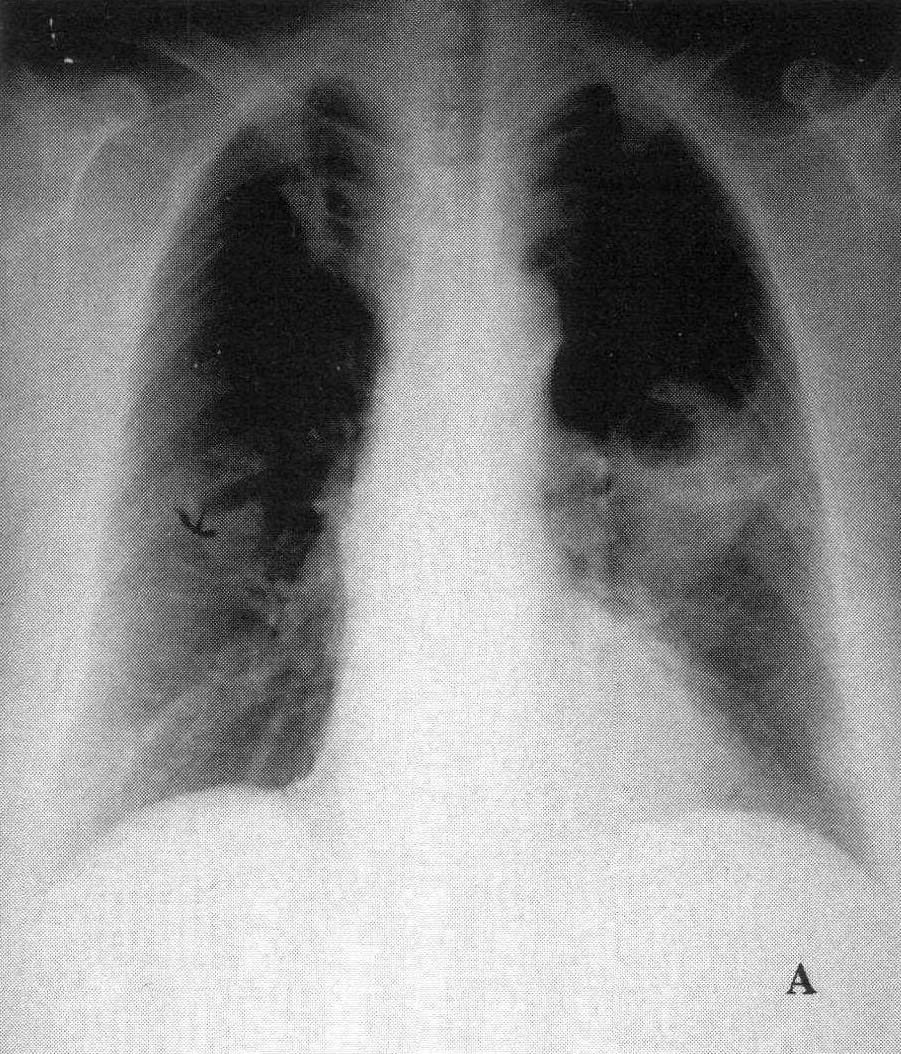 图2—253 肺化脓症